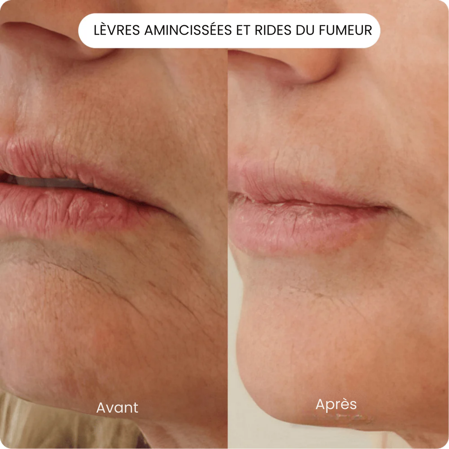 NOYA BEAUTY™ Micro-Infusion